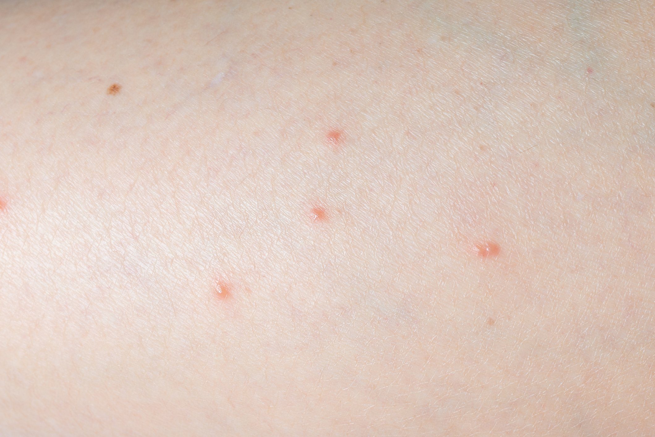 small insect bites on skin