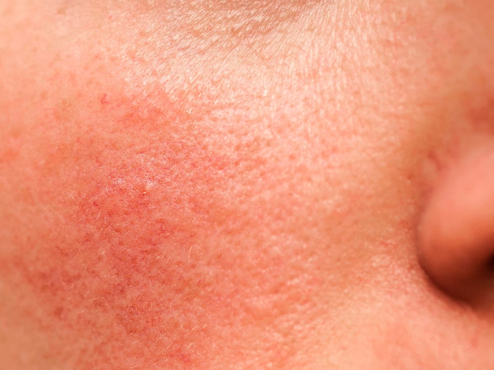 How to Tell the Difference Between Psoriasis, Rosacea, and Eczema - rosacea on face