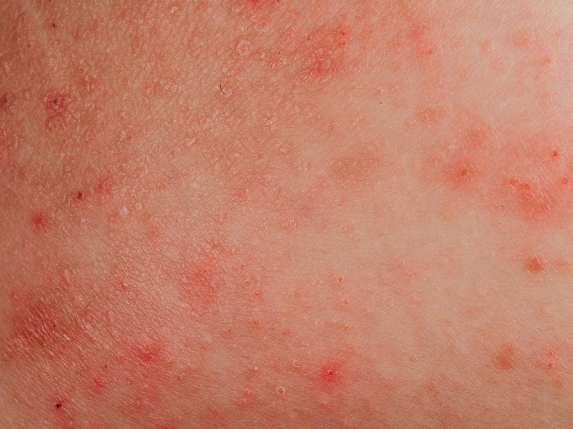 How to Tell the Difference Between Psoriasis, Rosacea, and Eczema - eczema allergy on skin