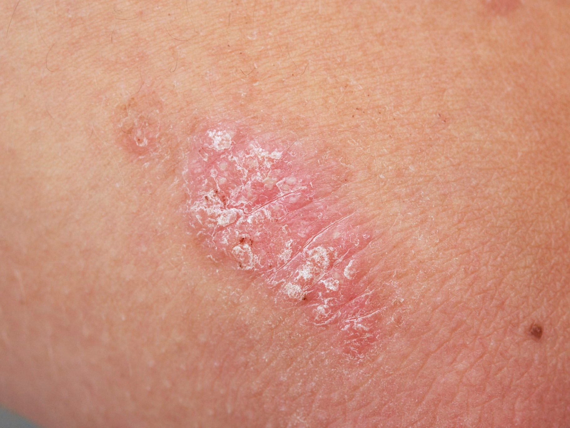 How to Tell the Difference Between Psoriasis, Rosacea, and Eczema - psoriasis on skin