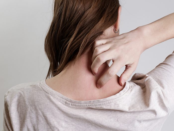 Symptoms of shingles - woman scratching neck