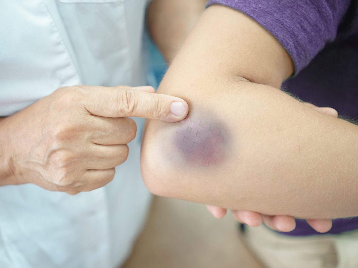 Woman with bruise on arm