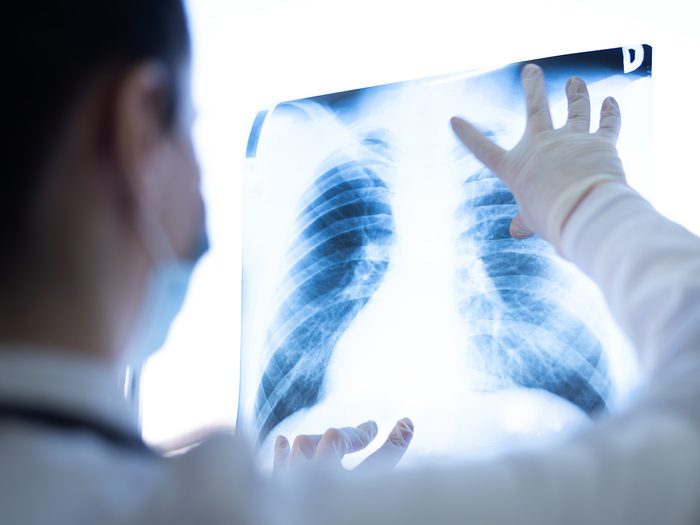 Lung cancer screening - doctor examining x-ray