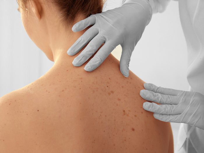 Skin changes - doctor examining patient's freckled back