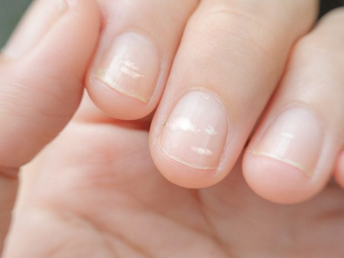 close up white spot on finger nails called leukonychia, sickness concept