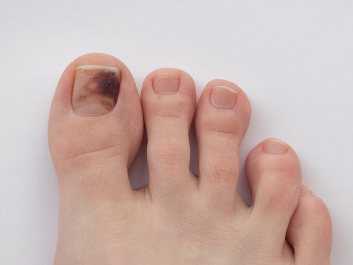 Discolored toenail