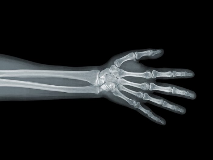 Signs you need more calcium - arm x-ray