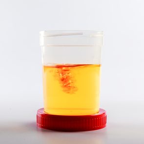 blood in urine - analysis as an idea of urogenital system disease and prostate cancer. disease based on the result of a urine test