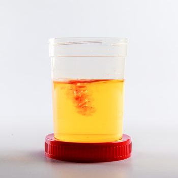 blood in urine - analysis as an idea of urogenital system disease and prostate cancer. disease based on the result of a urine test