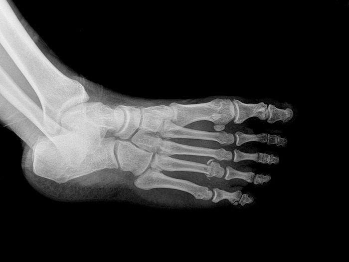 Vitamin D deficiency symptoms - x-ray of foot
