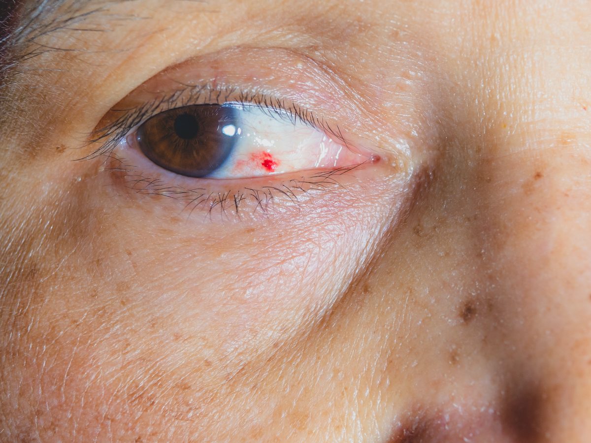 Red Spot in Eye