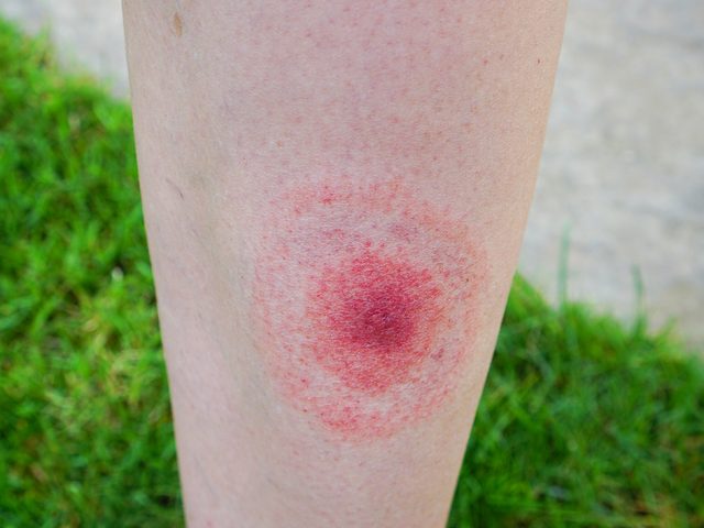 Tick borne disease in Canada - Lyme disease bullseye rash