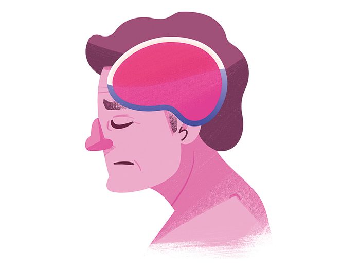 Brain Drain Illustration - CSF Leak headache