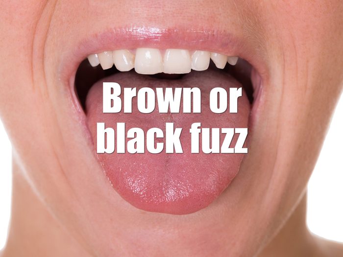 Health Clues Tongue - Brown Or Black Fuzz