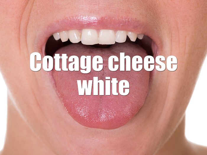 Health Clues Tongue - Cottage Cheese