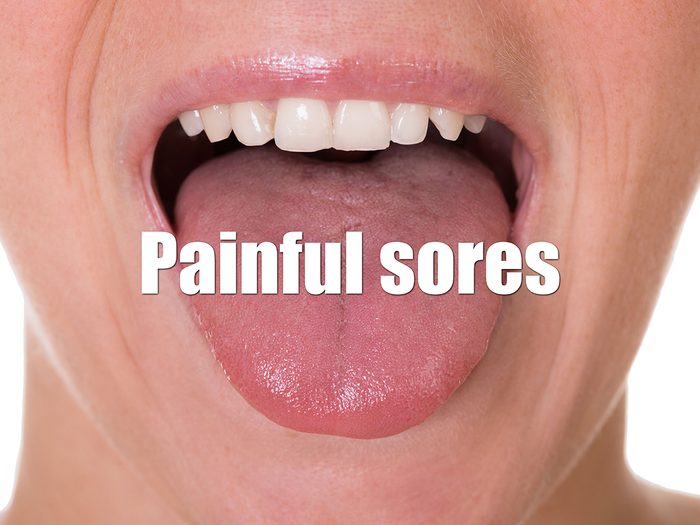 Health Clues Tongue - Painful Sores