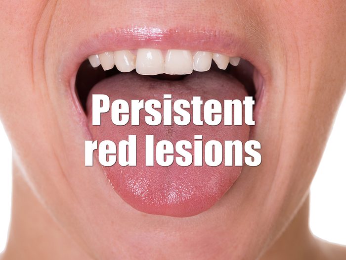 Health Clues Tongue - Red Lesions