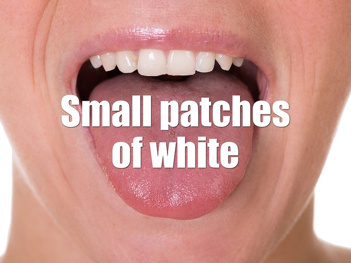Health Clues Tongue - Small Patches Of White