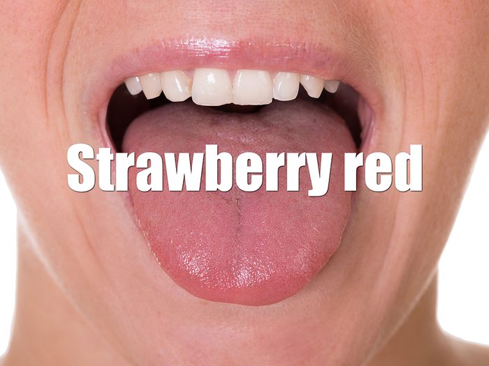 Health Clues Tongue - Strawberry Red