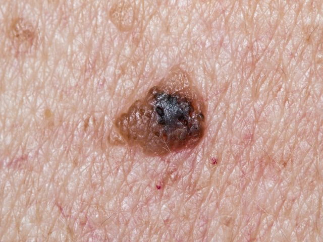 Skin Cancer Symptoms - A mole 