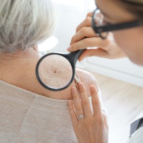 Skin Cancer Symptoms - Doctor examining older woman with magnifying glass