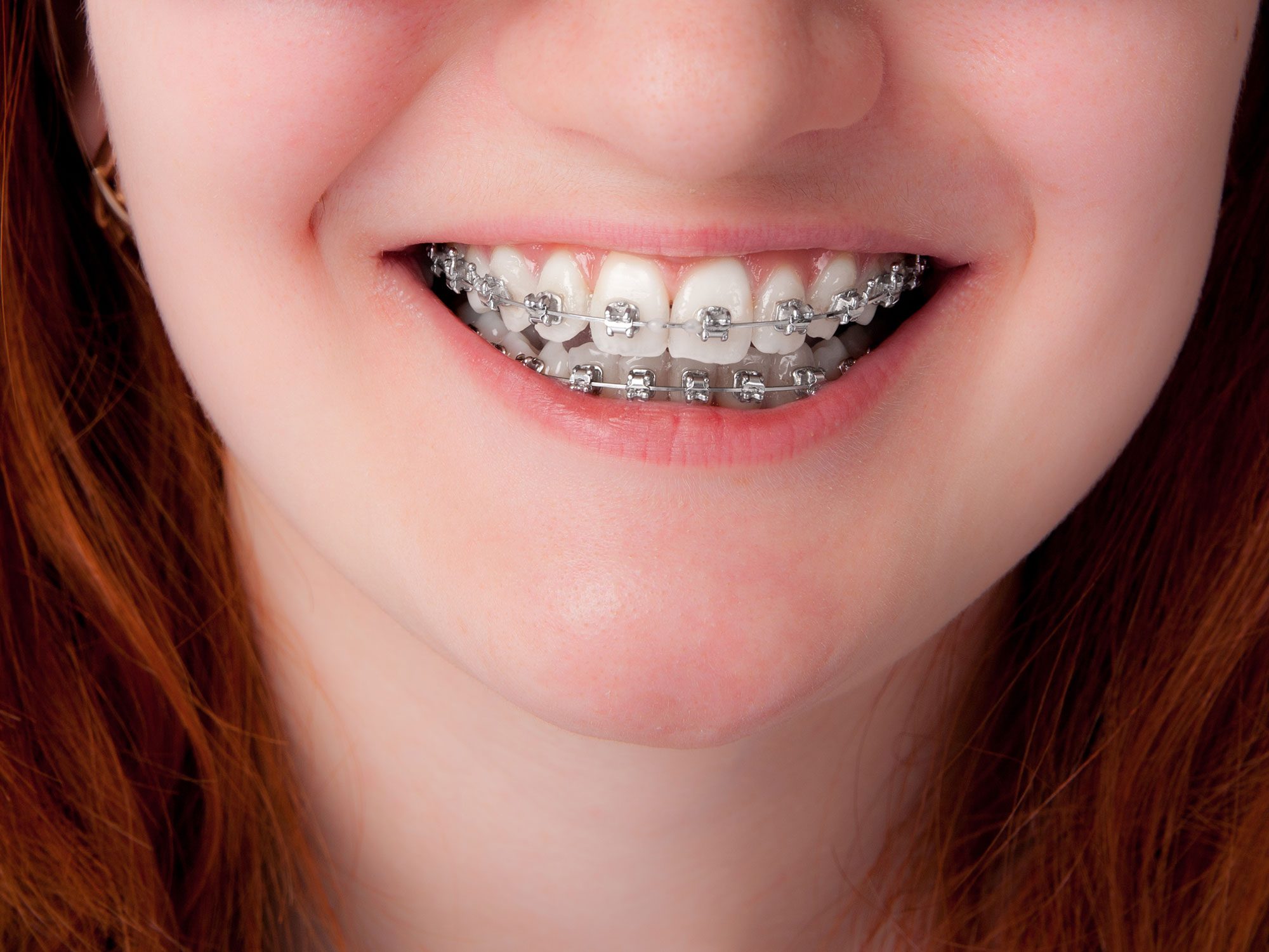 Does Your Child Really Need Braces: Weighing the Options